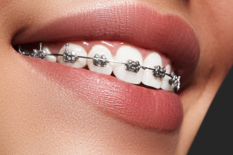 Misaligned Teeth, Get Braces From An Orthodontist! San Antonio